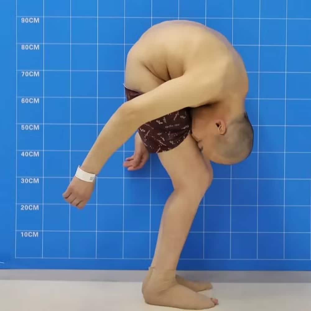 psicologiasdobrasil.com.br - Após cirurgia, 'Homem Dobrado' finalmente consegue ficar ereto e ter 'vida normal'