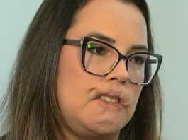 Mulher perde os lábios após se submeter a procedimento estético com PMMA