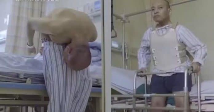 Após cirurgia, ‘Homem Dobrado’ finalmente consegue ficar ereto e ter ‘vida normal’