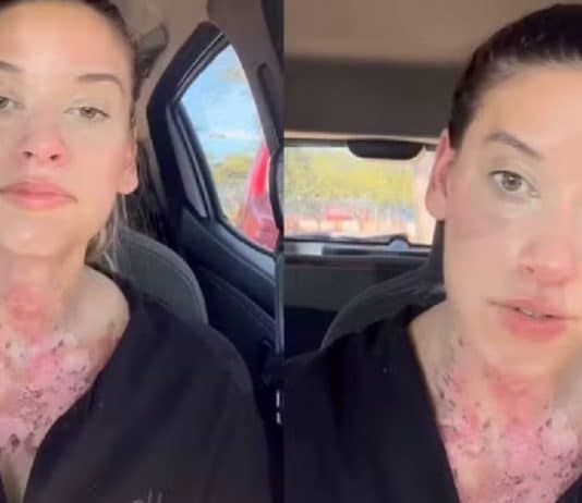 Jovem que se queimou ao checar água do carro faz desabafo: ‘Comentários mexeram mais comigo do que cicatrizes’