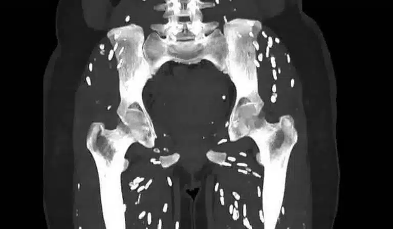psicologiasdobrasil.com.br - Tomografia revela efeito devastador de consumir carne de porco malpassada