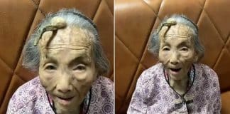 Entenda a condição que fez ‘chifre’ crescer em idosa de 107 anos na China