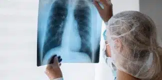 Anvisa aprova o 1º medicamento oral para câncer de pulmão em fase inicial