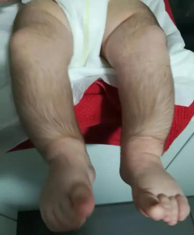 Minoxidil: Loção para calvície usada por pais faz crescer pelos em bebês psicologiasdobrasil.com.br - Minoxidil: Loção para calvície usada por pais faz crescer pelos em bebês