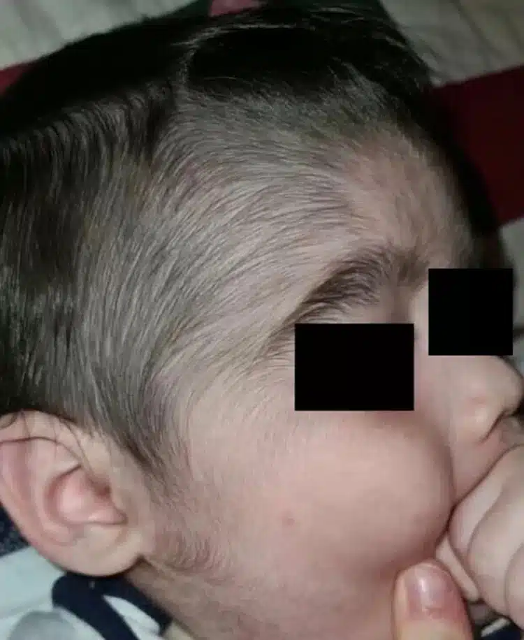 Minoxidil: Loção para calvície usada por pais faz crescer pelos em bebês psicologiasdobrasil.com.br - Minoxidil: Loção para calvície usada por pais faz crescer pelos em bebês