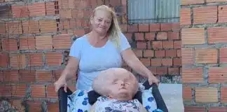Mãe de mulher com hidrocefalia gigante exibe sua rotina com a filha e vive de doações