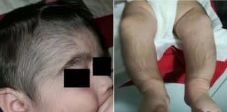 Minoxidil: Loção para calvície usada por pais faz crescer pelos em bebês