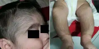 Minoxidil: Loção para calvície usada por pais faz crescer pelos em bebês