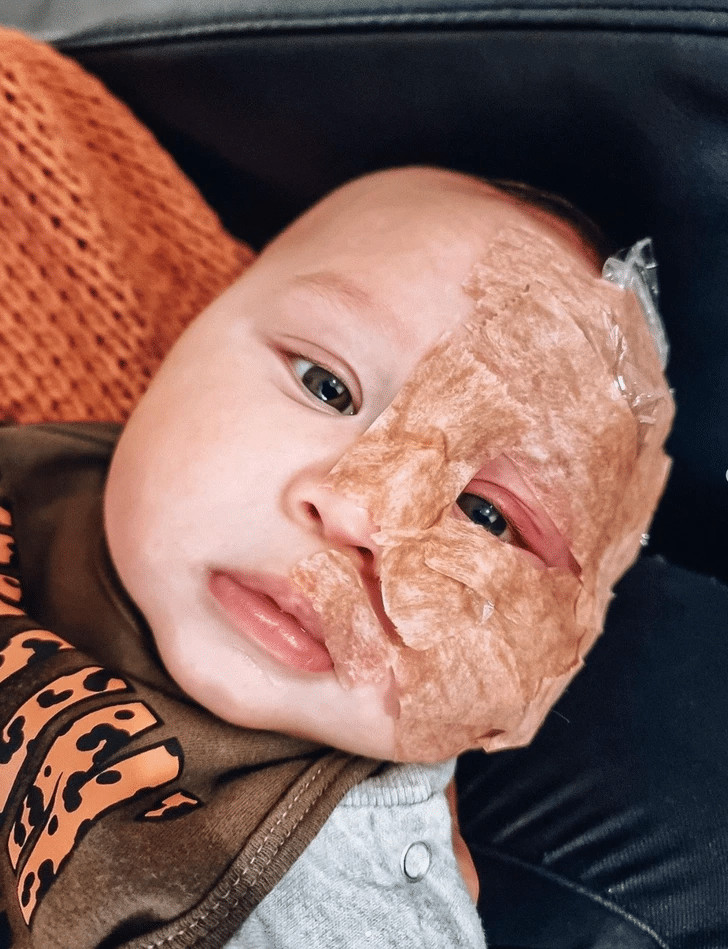 psicologiasdobrasil.com.br - M&atilde;e recebe enxurrada de cr&iacute;ticas por remover com laser a marca de nascen&ccedil;a de seu beb&ecirc;
