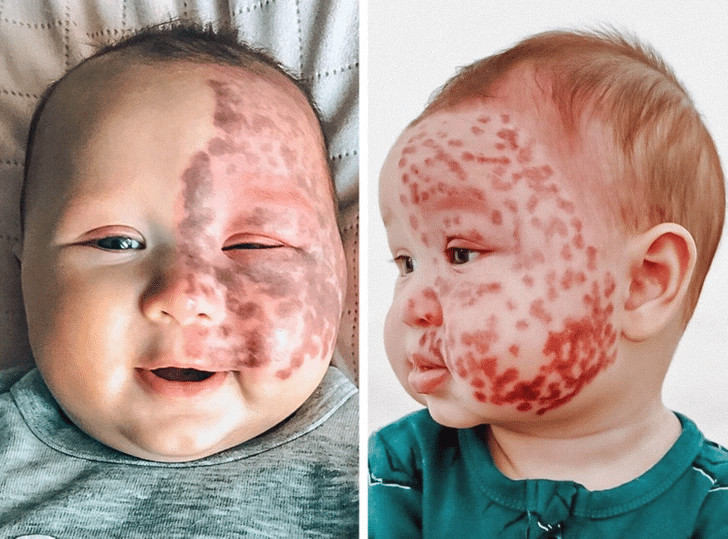 psicologiasdobrasil.com.br - M&atilde;e recebe enxurrada de cr&iacute;ticas por remover com laser a marca de nascen&ccedil;a de seu beb&ecirc;