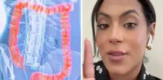 Mulher com câncer de cólon viraliza ao revelar os 5 sinais da doença que ela ignorou