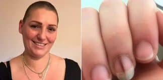 Mulher revela que detalhe na unha foi primeiro sinal de câncer terminal