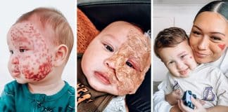 Mãe recebe enxurrada de críticas por remover com laser a marca de nascença de seu bebê