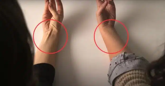 Faça este teste rápido com a mão: O simples gesto de encostar mindinho e polegar pode mostrar se você tem uma herança evolutiva rara