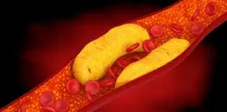 Cientistas descobriram uma maneira de desligar o colesterol e reduzir casos de infarto – veja como Cientistas descobriram uma maneira de desligar o colesterol e reduzir casos de infarto – veja como