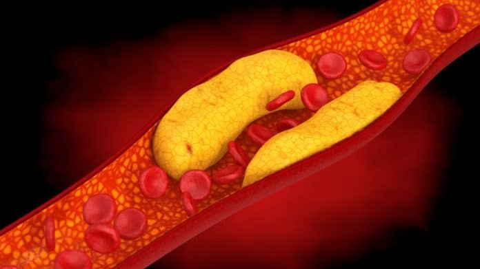 Cientistas descobriram uma maneira de desligar o colesterol e reduzir casos de infarto – veja como