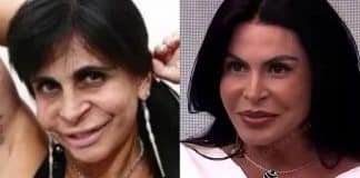 Médico surpreende ao mostrar transformação no rosto de Gretchen - conheça o nome da cirurgia que ela fez