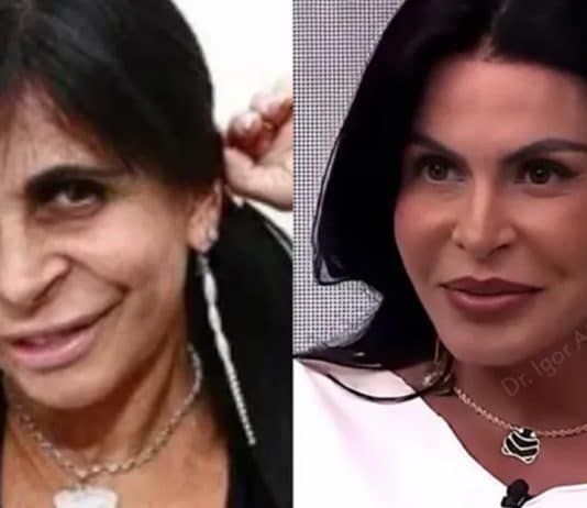 Médico surpreende ao mostrar transformação no rosto de Gretchen - conheça o nome da cirurgia que ela fez