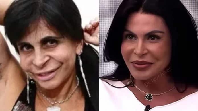 Médico surpreende ao mostrar transformação no rosto de Gretchen – conheça o nome da cirurgia que ela fez
