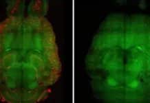 Novo tratamento com nanopartículas remove placa do Alzheimer e reverte a doença em testes de laboratório Novo tratamento com nanopartículas remove placa do Alzheimer e reverte a doença em testes de laboratório