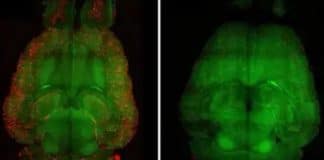 Novo tratamento com nanopartículas remove placa do Alzheimer e reverte a doença em testes de laboratório