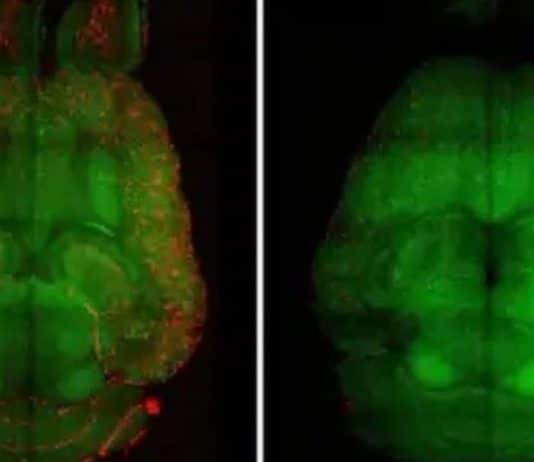 Novo tratamento com nanopartículas remove placa do Alzheimer e reverte a doença em testes de laboratório Novo tratamento com nanopartículas remove placa do Alzheimer e reverte a doença em testes de laboratório