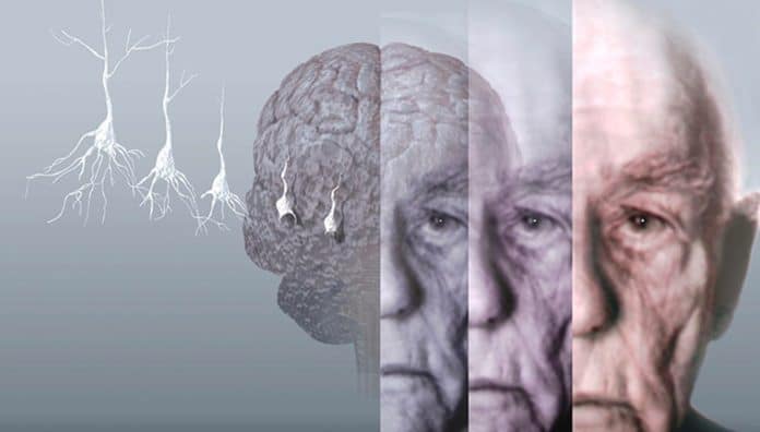 Quando chega ao SUS? Exame de sangue criado por cientistas brasileiros pode detectar Alzheimer com até 90% de precisão