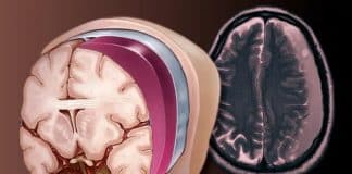 casos de derrame em pessoas com menos de 40 anos estão aumentando