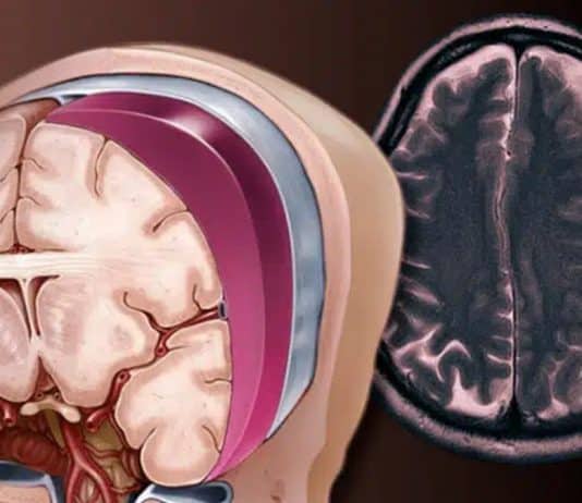 casos de derrame em pessoas com menos de 40 anos estão aumentando